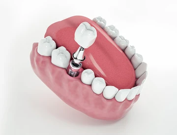 Dental-treatment-and-dental-implants,-India