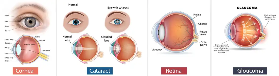 Eye-Diseases-Treatment--LV-Prasad-Eye-Institute,-Hyderabad