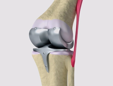 Orthopedic-and-Joint-Replacement-Surgery,-India
