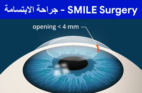 Smile-Surgery---جراحة-الابتسامة