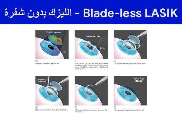 الليزك-بدون-شفرة---Blade-less-LASIK