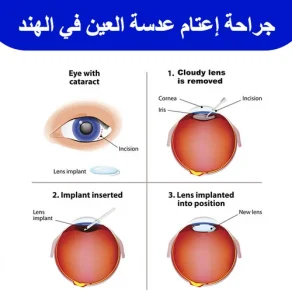 جراحة-إعتام-عدسة-العين-في-الهند
