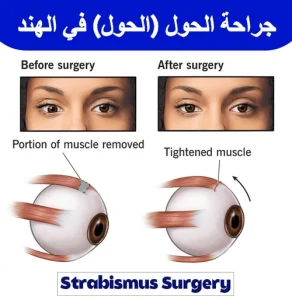 جراحة-الحول-في-الهند