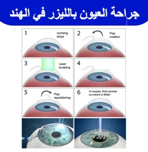 جراحة-العيون-بالليزر-في-الهند