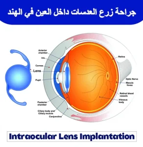 جراحة-زرع-العدسات-داخل-العين-في-الهند