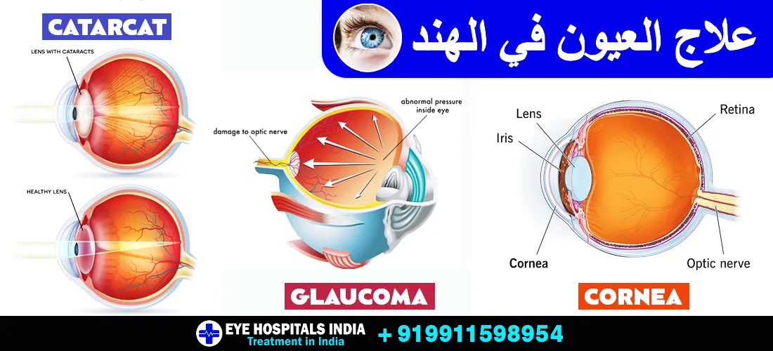 علاج-العيون-في-الهند