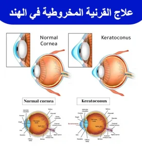 علاج-القرنية-المخروطية-في-الهند