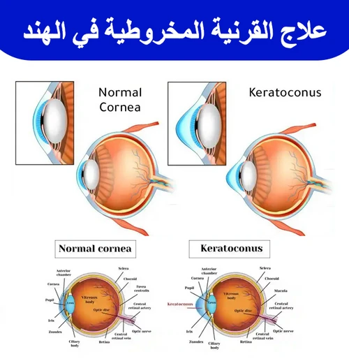 علاج-القرنية-المخروطية-في-الهند