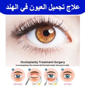 علاج-تجميل-العيون-في-الهند