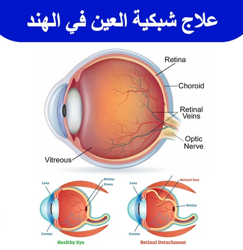 علاج-شبكية-العين-في-الهند
